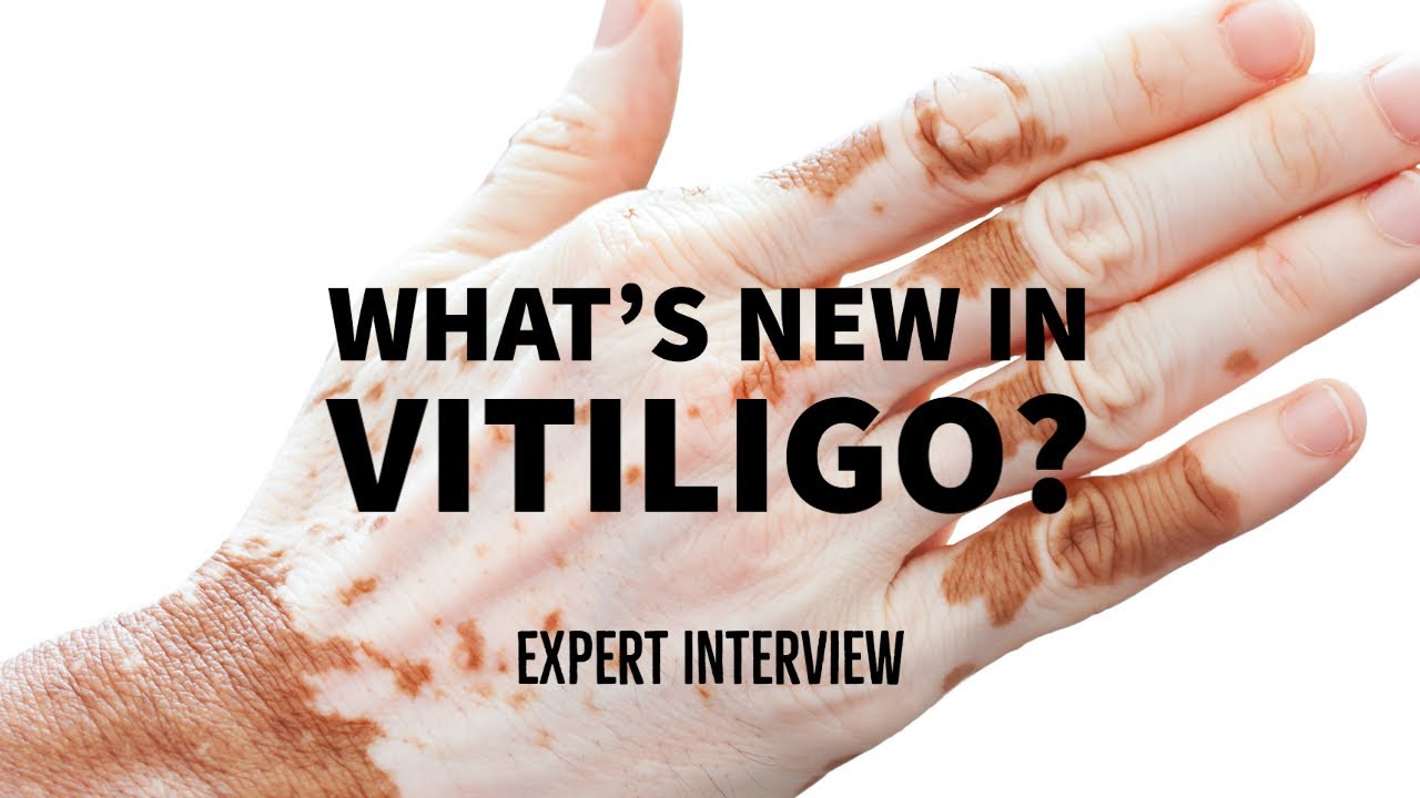 new research vitiligo cure