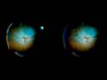 (3D).(Rw.Mentor).The Unforgiving Detachment: Vitrectomy in Severe Chronic Macula‑Off RD