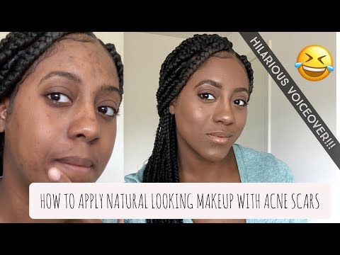 HOW TO APPLY NATURAL MAKEUP WITH ACNE SCARS! |HILARIOUS VOICEOVER