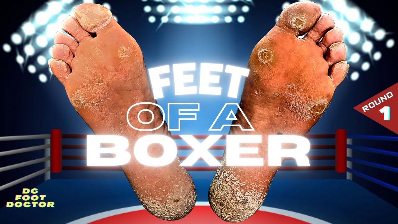 Feet of a Boxer Knocking Out Painful Calluses, Round 1 Toes