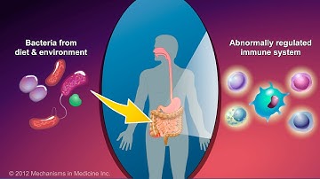 Wat is de ziekte van Crohn?