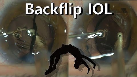 Backflip IOL. Intraocularly flip a plate haptic multifocal IOL.