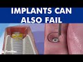 Peri-implantitis - Dental implant failure ©