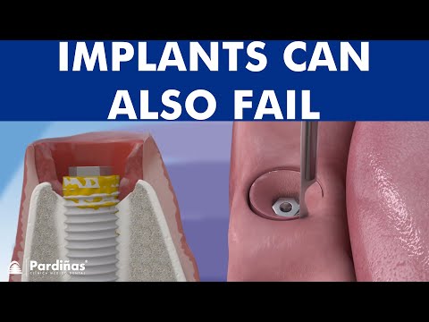 Peri-implantitis - Dental implant infection ©