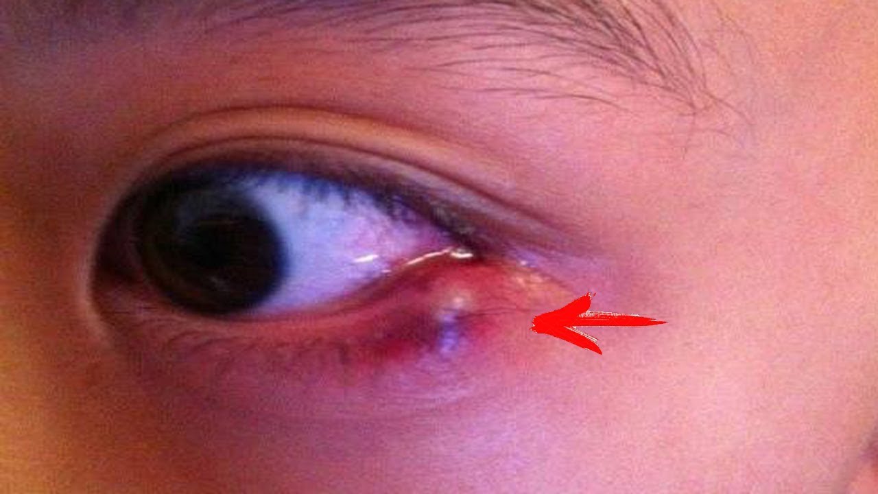 Фурункулы, нарывы и чирьи выходят сами. 7 способов избавиться от ...