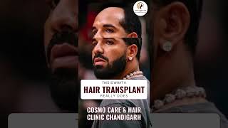 The Power of Hair Transplant ✨ Amazing Transformation