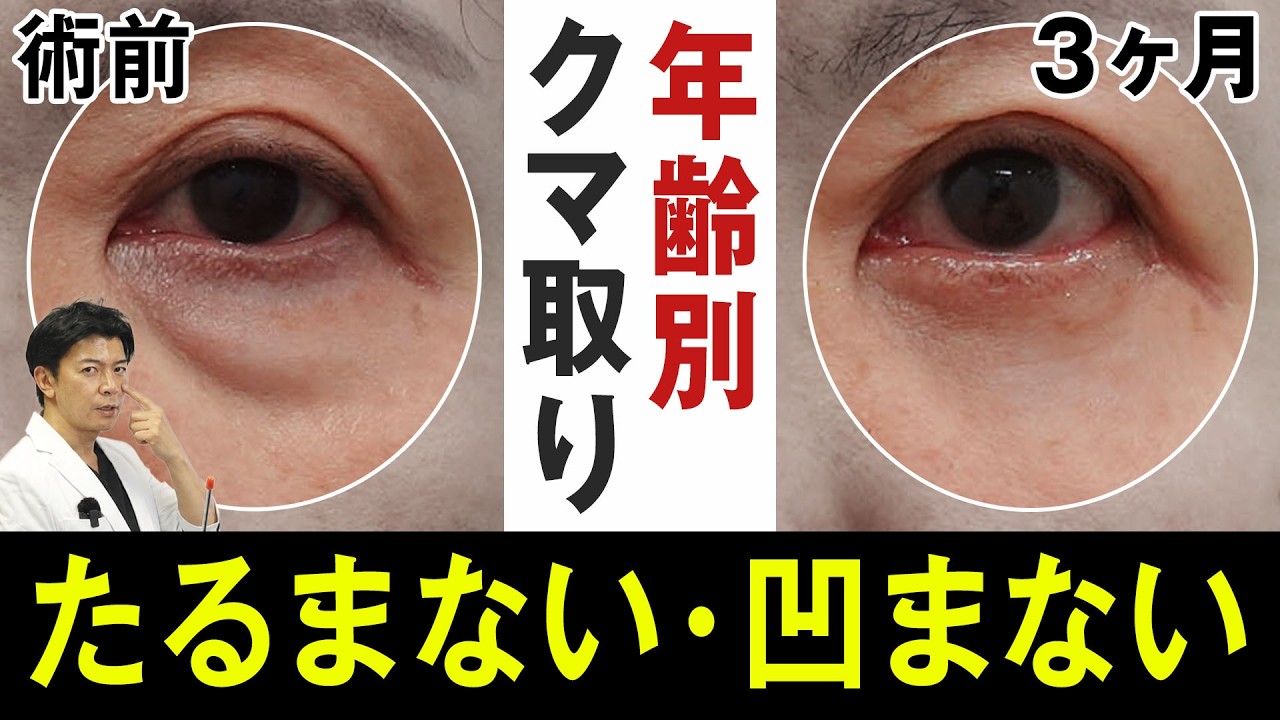 【クマ取り】15症例解説!30〜60代の目の下のたるみ・クマ治療のリアル