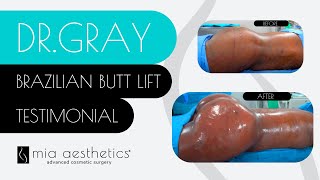 BBL Before & After By Dr. Gray - Brazilian Butt Lift At Mia Aesthetics