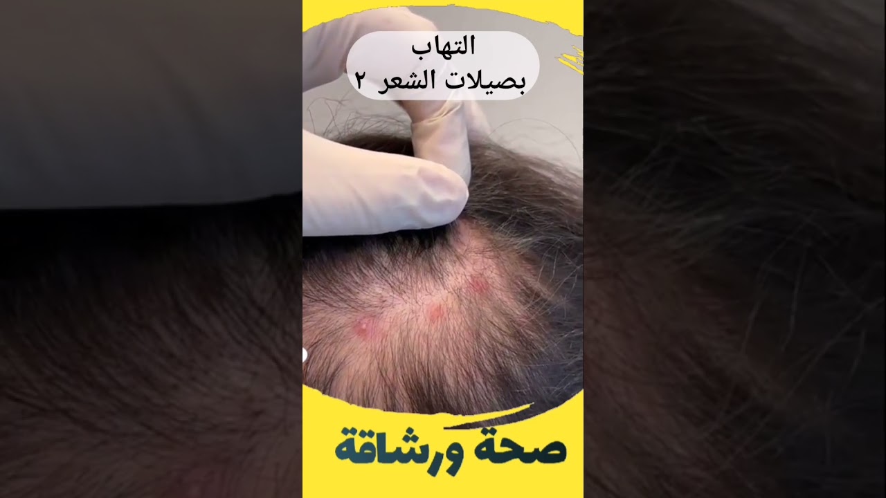 التهاب بصيلات الشعر - 2 -  د. أنور الحمادي