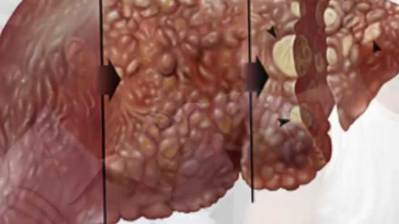 ¿Cómo se contagia la hepatitis? | Vias de transmisión de ¿Cómo se contagia la hepatitis? | Vias de transmisión de