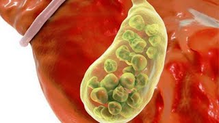 видео: ӨТТЕ ТАС БОЛУЫНЫҢ 5 БЕЛГІСІ . ҚАЛАЙ ТҮСІРУГЕ БОЛАДЫ? картинка: ӨТТЕ ТАС БОЛУЫНЫҢ 5 БЕЛГІСІ . ҚАЛАЙ ТҮСІРУГЕ БОЛАДЫ?