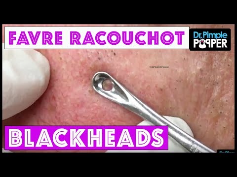 Favre Racouchot Blackheads In Sigh Man...