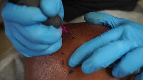 Self confidence in the making, Scalp Micro Pigmentation