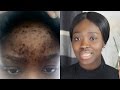 HOW TO : CLEAR ACNE ON A BUDGET!!!(Real Life, Quick Results)