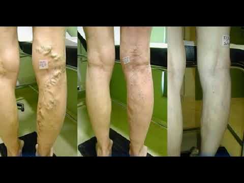 heal-your-varicose-veins-with-a-mix-of-aloe-vera,-carrot-and-apple-cider-vinegar