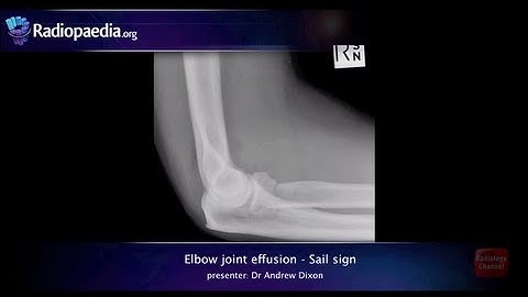 Elbow joint effusion and the sail sign - radiology video tutorial (x-ray)