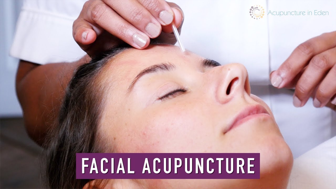 Facial Acupuncture Youtube