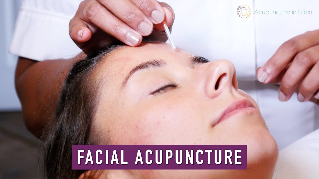 FACIAL ACUPUNCTURE YouTube