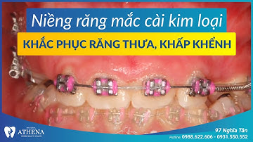 Niềng răng mắc cài kim loại - khắc phục răng thưa, khấp khểnh | Nha khoa quốc tế Athena