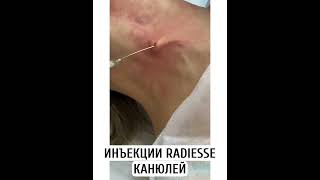 Убираем дряблость кожи на шее. Препарат Радиесс (Radiesse) канюльная техника.