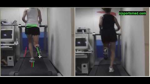 Video Gait Running Analysis: Alignment Issues, Rear View