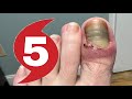 CATEGORY 5 NAIL INFECTION