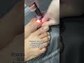 Nail Fungus Laser Treatment at Dr. MediSpa