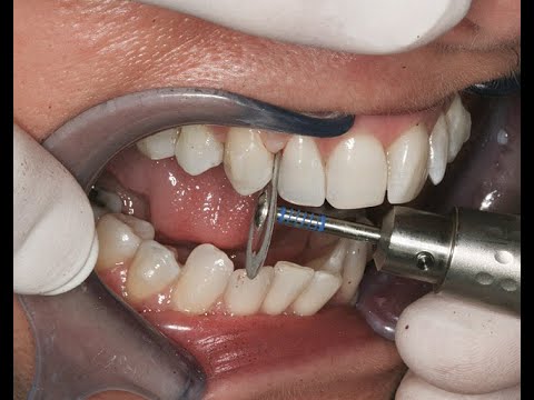 Video: Interproximal Kavitet: En Kavitet Mellan Tänder