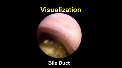 Direct Visualization of Biliary & Pancreatic Ducts using the SpyGlass® System