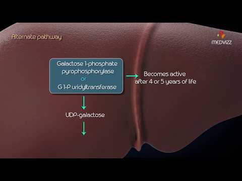 Metabolism of galactose: Classic Galactosemia, Galactokinase deficiency