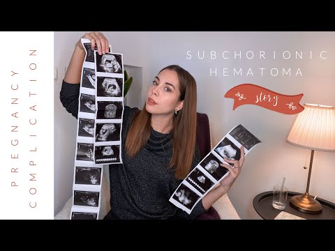 Video: Puas yog Subchorionic hematoma suav tias muaj kev pheej hmoo siab?