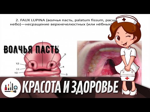 Видео: Какой тип расстройства - волчья пасть?