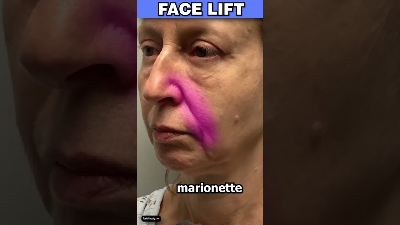 Before & After Facelift Results!