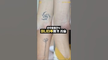미니 타투 제거 시술 회차별 변화과정 보기 #문신제거 #타투제거