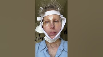 Facelift Healing Timeline 2 Months Post Op