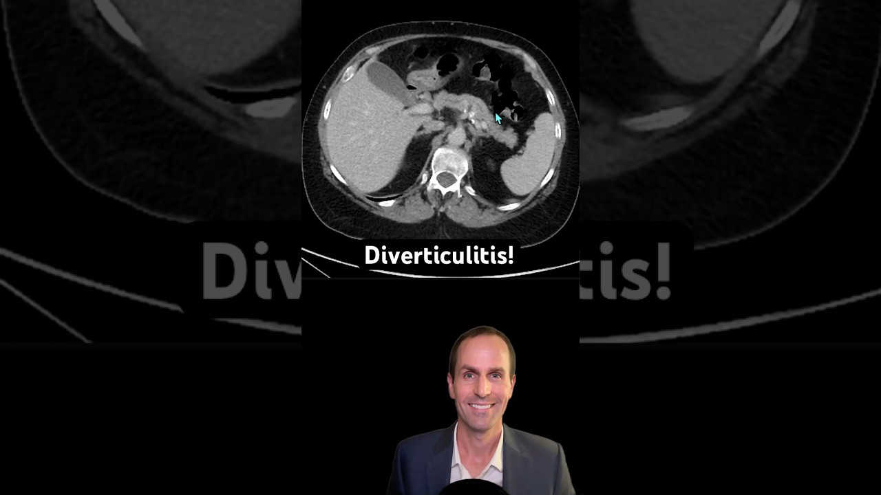 Abdominal CT Tutorials - Diverticulitis