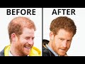 Prince Harry&#39;s Hair Transplant | Plastic Surgery Analysis