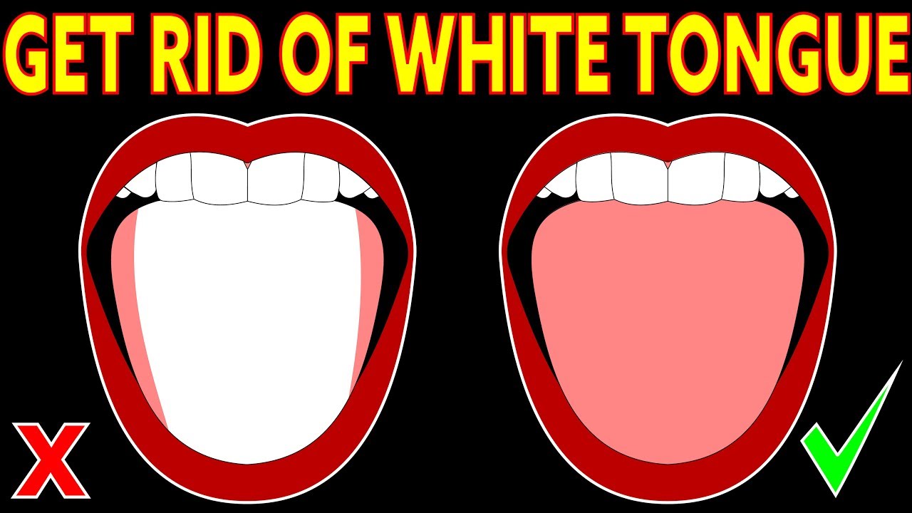 How To Get Rid Of White On Tongue