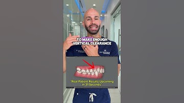 Fixing a crossbite with Invisalign. Real patient results in 6 months!!