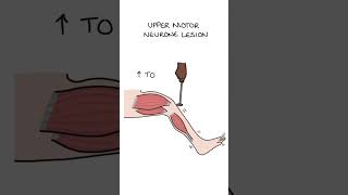 Upper Versus Lower Motor Neurone Lesions #neurology #medicine #clinicalexamination