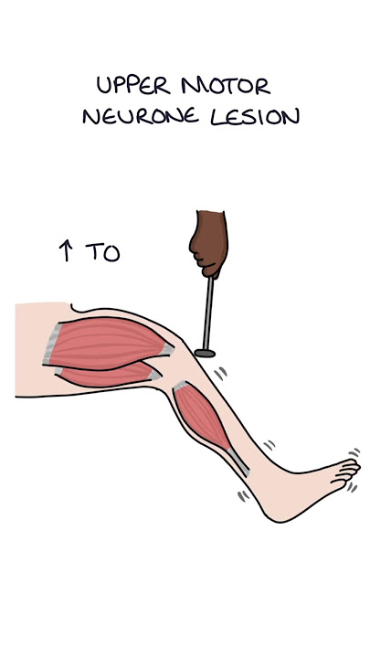 Upper Versus Lower Motor Neurone Lesions #neurology #medicine #clinicalexamination