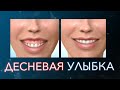 Десневая улыбка. Как исправить. Коррекция десневой улыбки.