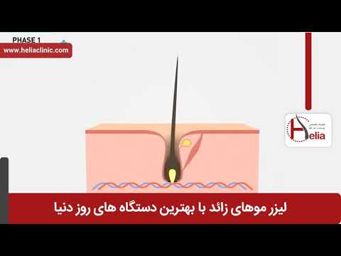 لیزر موهای زائد فیلم لیزر موهای زائد کلینیک پوست و مو هلیا شماره 18 
