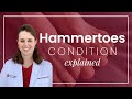 What Are Hammertoes?