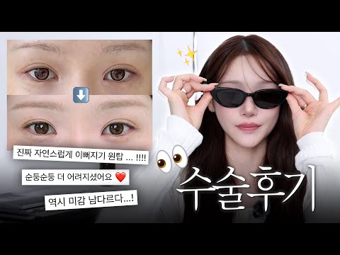 자연스럽게 예뻐지기 원탑☝🏻눈 수술 18일차 후기