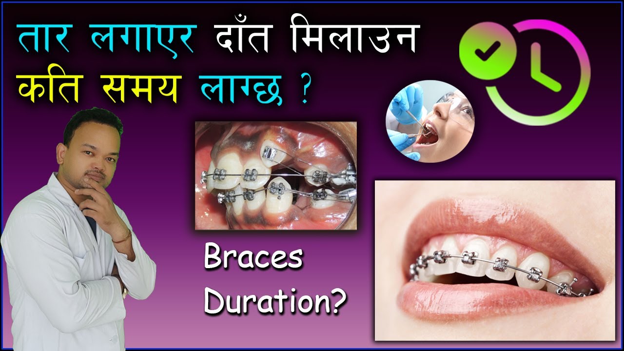तार लगाएर दाँत मिलाउन कति समय लाग्छ?/How much time is required to complete braces treatment? 