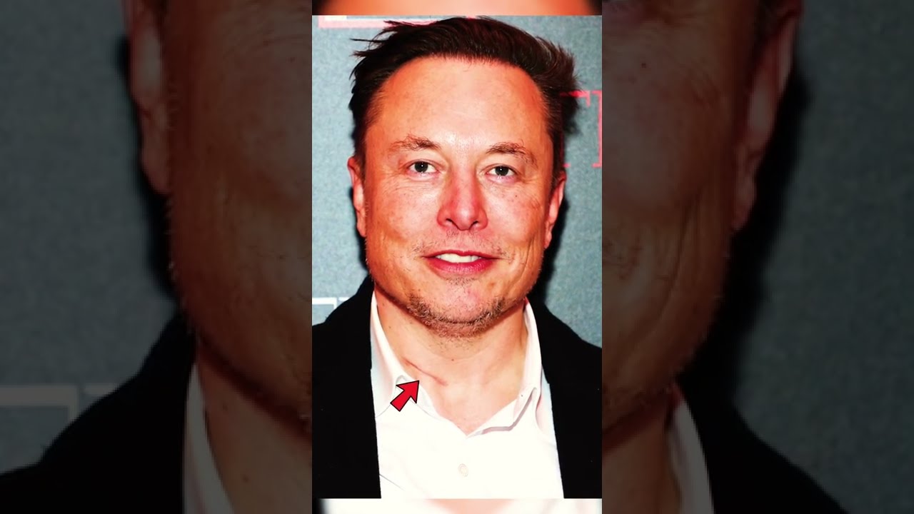 Elon Musk could’ve prevented failed surgery on his neck🤭 // What Could