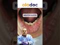 Why Do Mouth Ulcers Form Know The Treatment Shorts Mouthulcer Mouthulcertreatment 