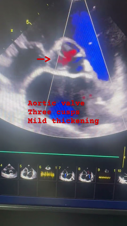 Aortic valve, 3 cusps, on echo #cardiology #echocardiography #echo #basics