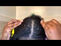 Satisfying Dandruff Removal | Dry Flakes #dandruff #dandruffscratching #psoriasis